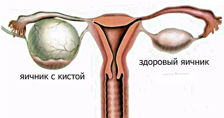 Где Яичники У Женщин Фото